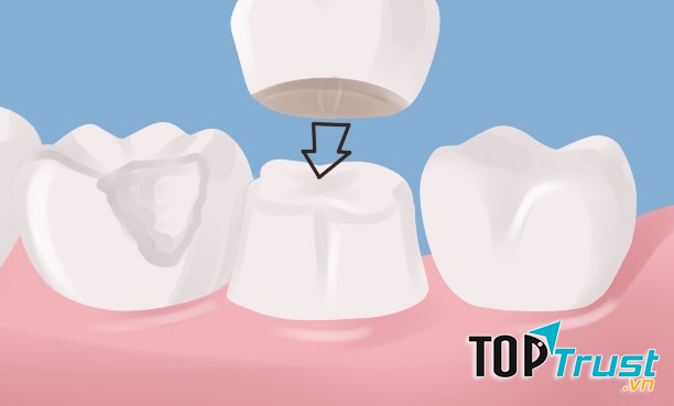 Địa chỉ bọc răng sứ thẩm mỹ tốt nhất tại quận 2, TP HCM