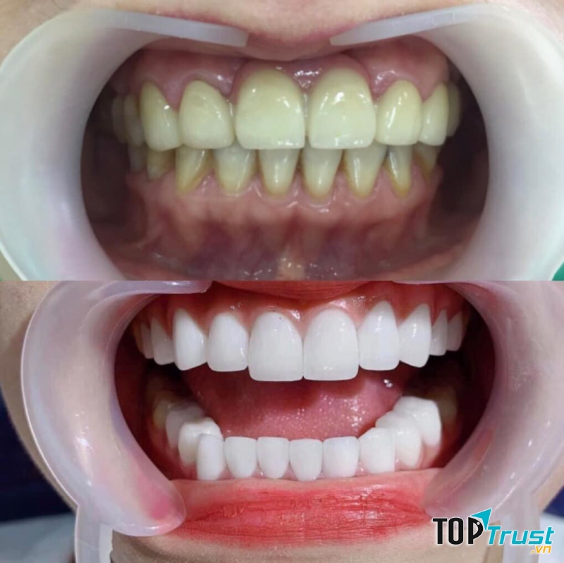 Địa chỉ bọc răng sứ thẩm mỹ tốt nhất tại quận 3, TP HCM