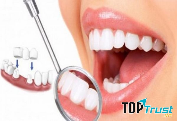 Địa chỉ bọc răng sứ thẩm mỹ tốt nhất tại quận Hai Bà Trưng, Hà Nội