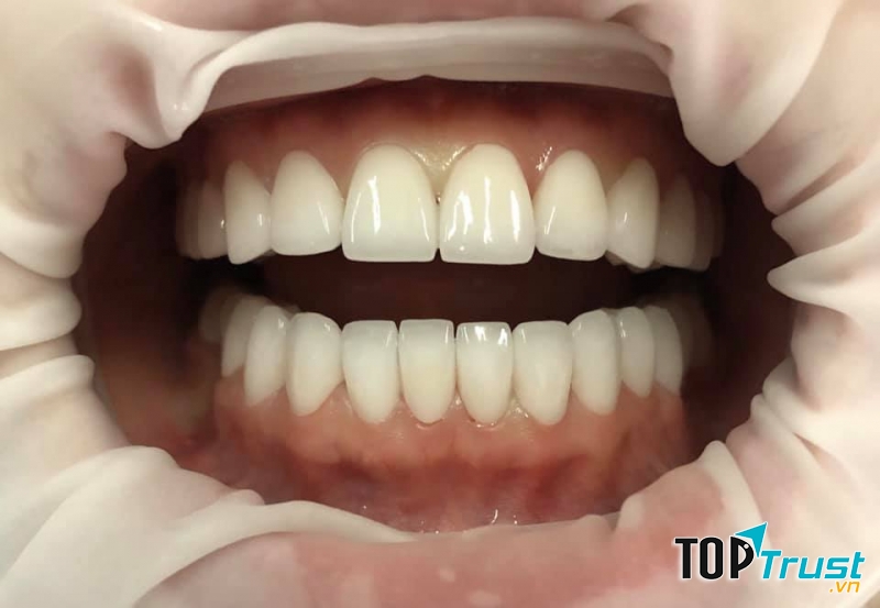 Địa chỉ bọc răng sứ uy tín nhất Quảng Bình