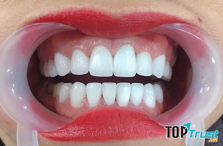 Địa chỉ bọc răng sứ uy tín nhất Quảng Nam
