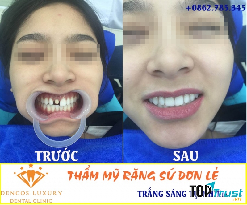 Địa chỉ bọc răng sứ uy tín nhất Thanh Hóa