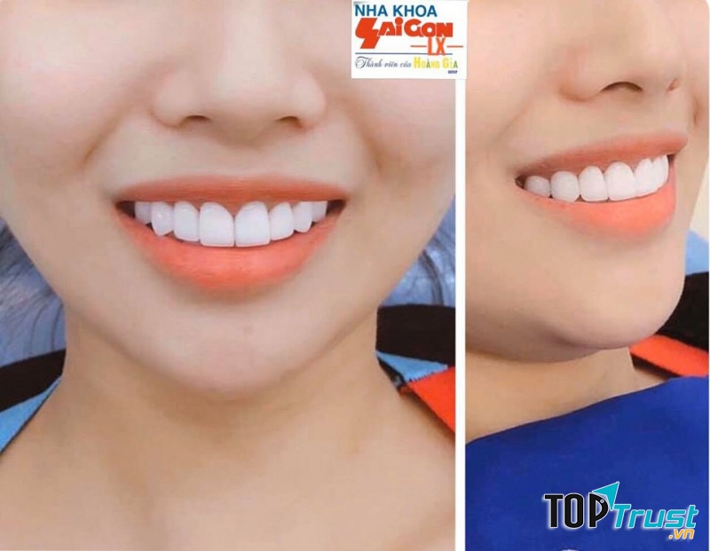 Địa chỉ bọc răng sứ uy tín nhất TP. Long Xuyên, An Giang