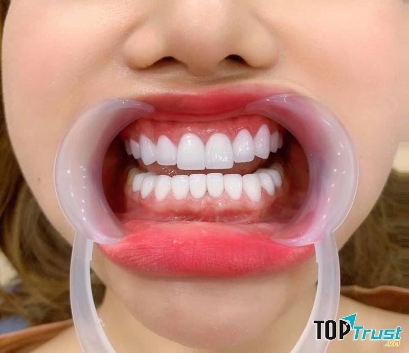 Địa chỉ bọc răng sứ uy tín nhất TP Quy Nhơn, Bình Đinh