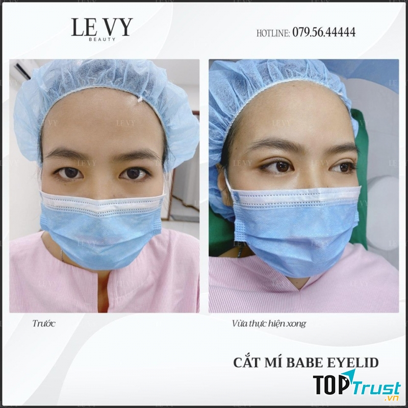 Địa chỉ cắt mí đẹp và an toàn nhất quận 10, TP. HCM