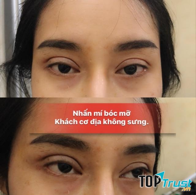 Địa chỉ cắt mí, nhấn mí đẹp và chất lượng nhất Hà Tĩnh