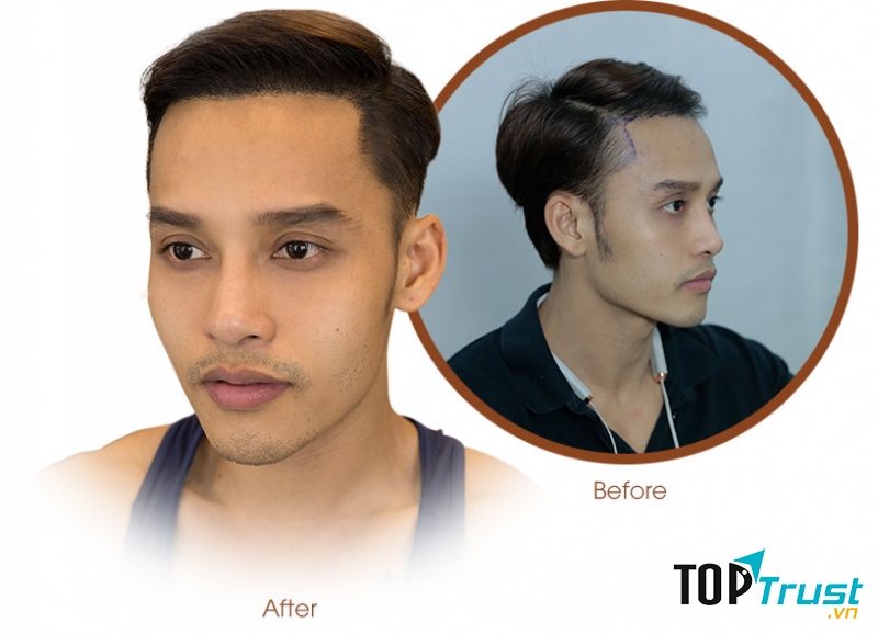 địa chỉ cấy tóc uy tín nhất tại Tp HCM