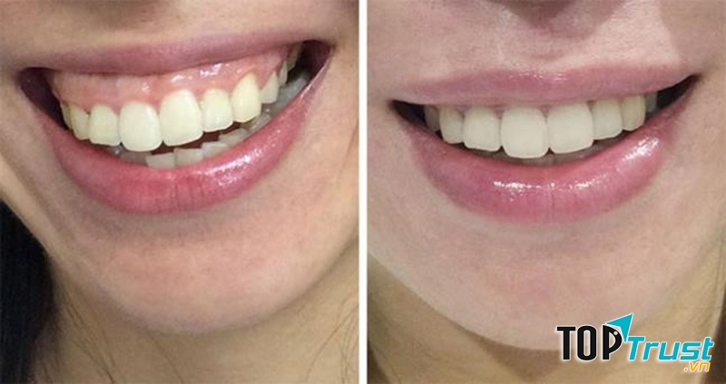 địa chỉ chữa cười hở lợi uy tín nhất ở Đà Nẵng