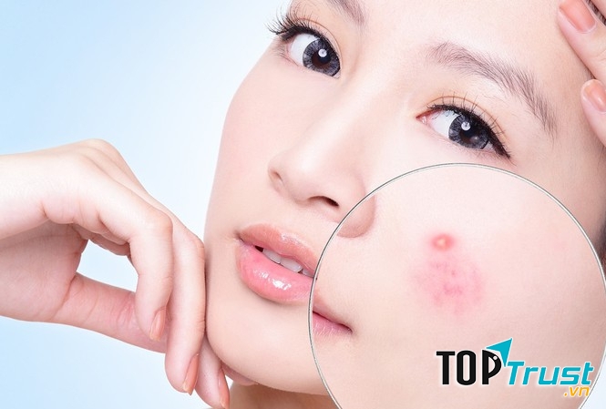 địa chỉ chữa mụn trứng cá tốt nhất ở Hà Nội