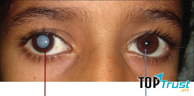 địa chỉ điều trị đục thủy tinh thể chất lượng nhất tại Hà Nội