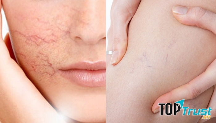 Địa chỉ điều trị giãn mao mạch hiệu quả nhất Hà Nội