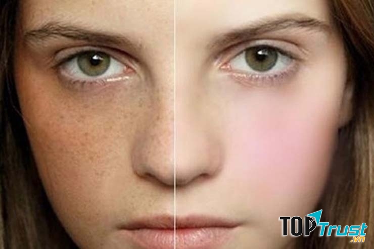 địa chỉ điều trị nám, tàn nhang chất lượng nhất Hà Nội