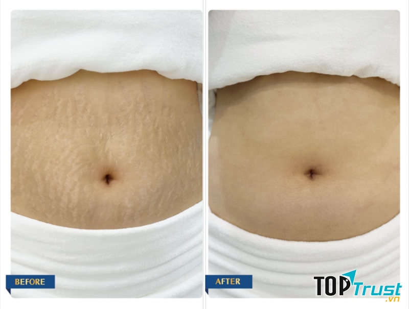 Địa chỉ điều trị rạn da uy tín nhất Hải Phòng