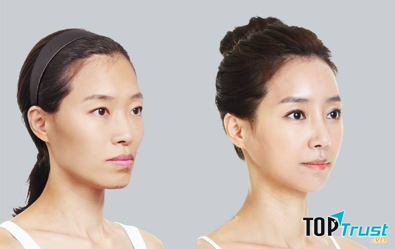 địa chỉ hạ gò má đẹp và an toàn nhất ở Hà Nội