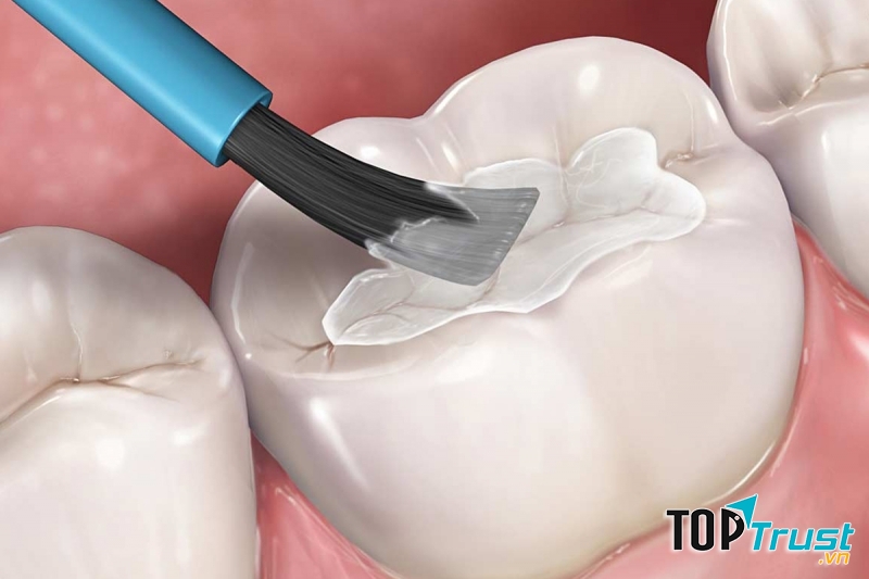 địa chỉ hàn (trám) răng hiệu quả tốt nhất tại Hà Nội