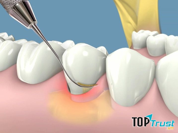Địa chỉ lấy cao răng an toàn và uy tín nhất ở Hà Nội
