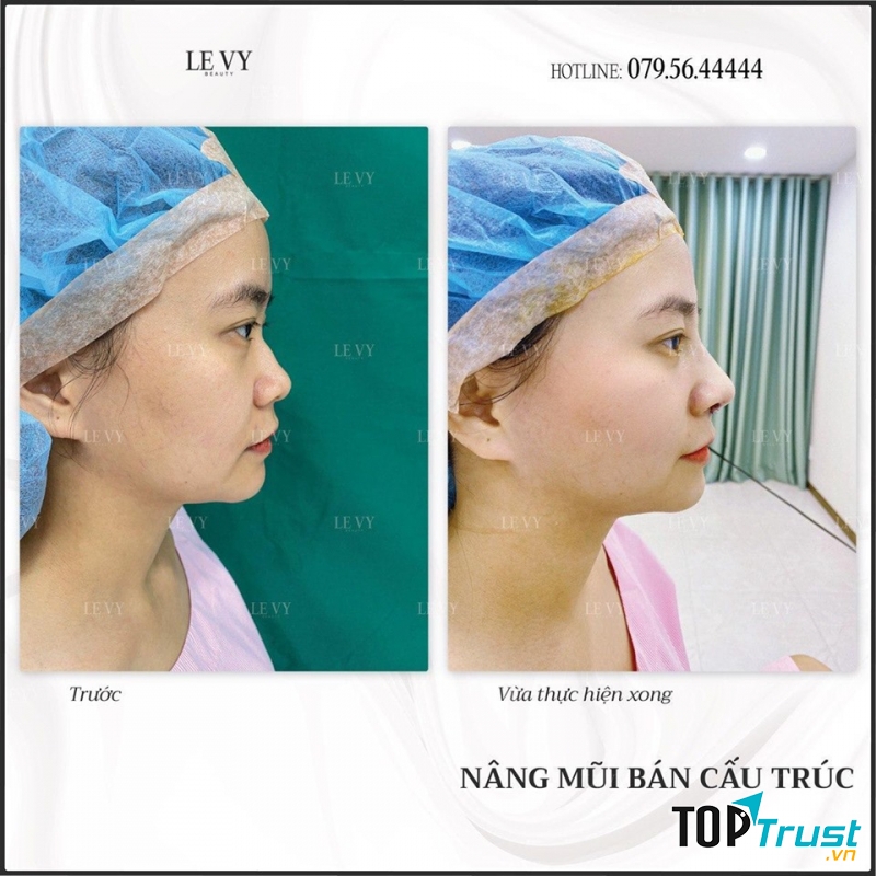 Địa chỉ nâng mũi đẹp và an toàn nhất quận 10, TP. HCM