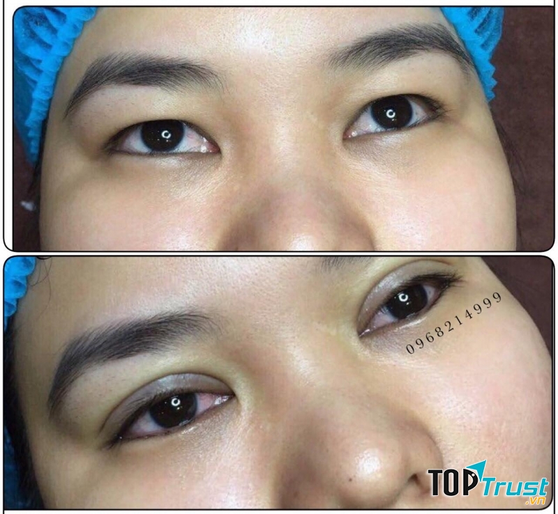 Địa chỉ nhấn mí, cắt mí đẹp và an toàn nhất Tuyên Quang