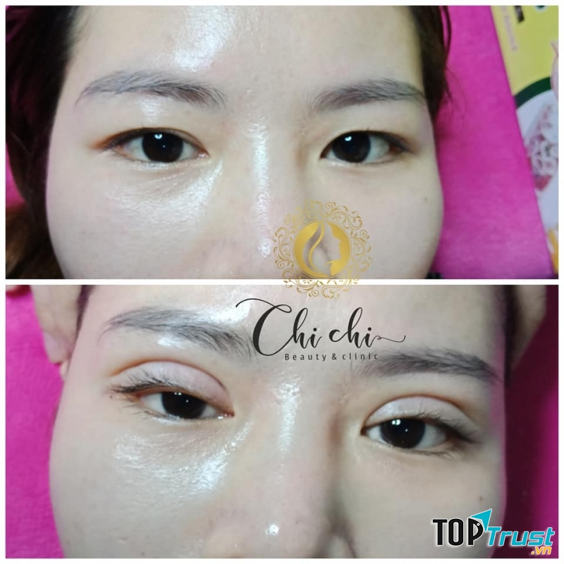 Địa chỉ nhấn mí đẹp và an toàn nhất Rạch Giá, Kiên Giang