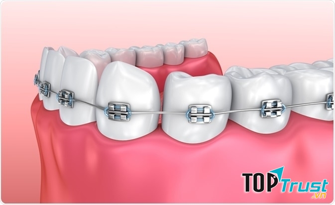 địa chỉ niềng răng uy tín hàng đầu tại Hà Nội