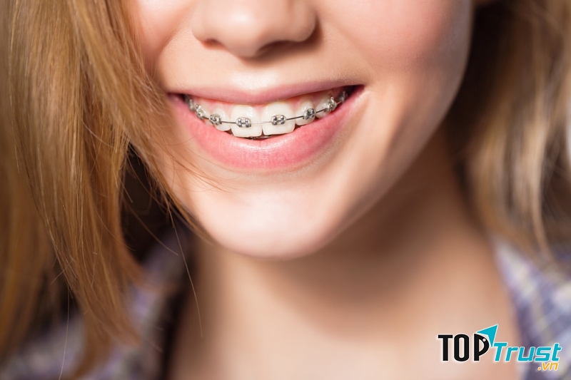 Địa chỉ niềng răng uy tín nhất quận 1, TP. HCM