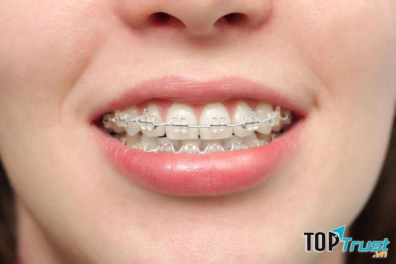 Địa chỉ niềng răng uy tín nhất quận 10, TP. HCM