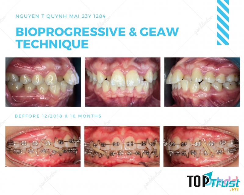 Địa chỉ niềng răng uy tín nhất quận 4, TP. HCM