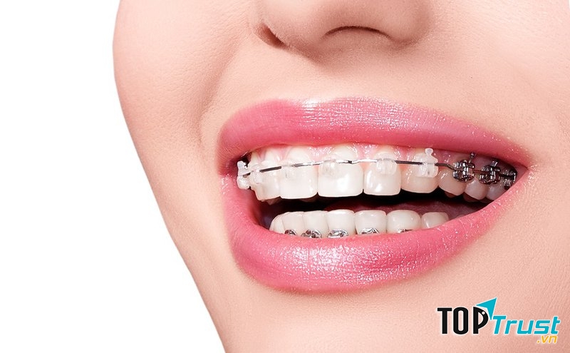 Địa chỉ niềng răng uy tín nhất quận Tân Bình, TP. HCM