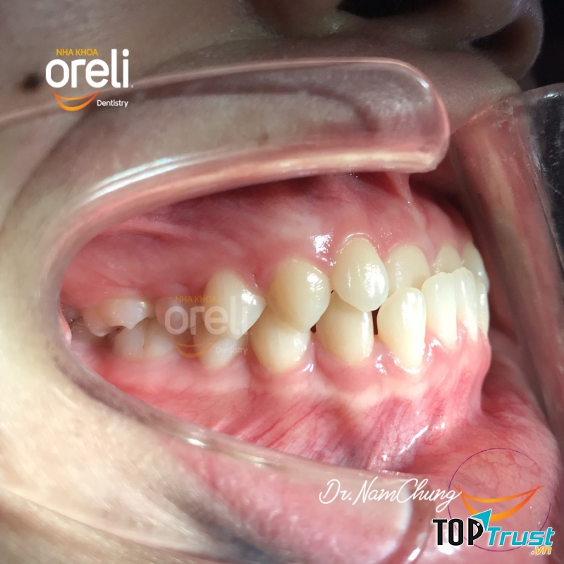 địa chỉ niềng răng uy tín nhất tại TP Buôn Ma Thuột