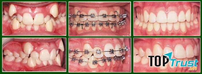 địa chỉ niềng răng uy tín nhất Thái Nguyên