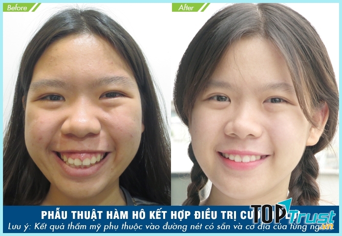 địa chỉ phẩu thuật hàm hô uy tín nhất Tp HCM