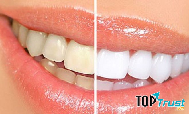địa chỉ tẩy trắng răng hiệu quả, an toàn nhất tại Tp HCM