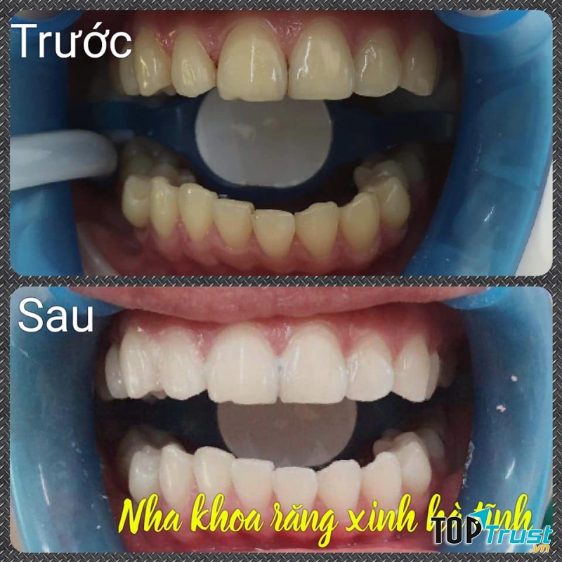 Địa chỉ tẩy trắng răng uy tín nhất Hà Tĩnh