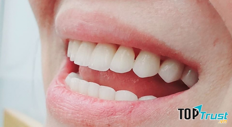 Địa chỉ tẩy trắng răng uy tín nhất Nam Định