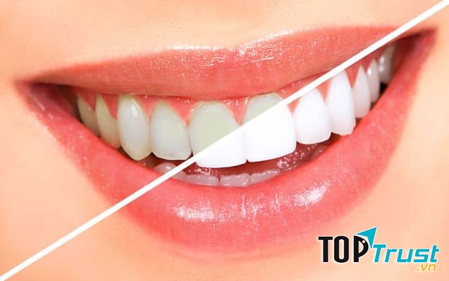 Địa chỉ tẩy trắng răng uy tín nhất Ninh Bình