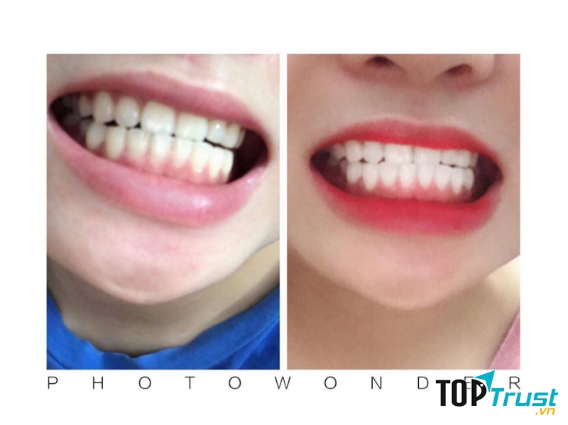 Địa chỉ tẩy trắng răng uy tín nhất Thanh Hóa