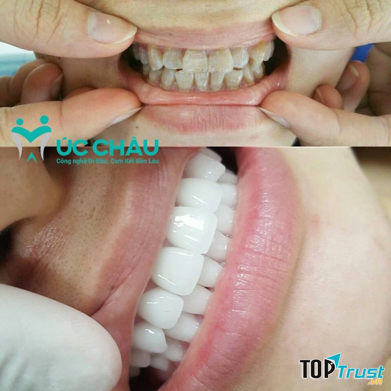 Địa chỉ tẩy trắng răng uy tín nhất TP. Hạ Long, Quảng Ninh