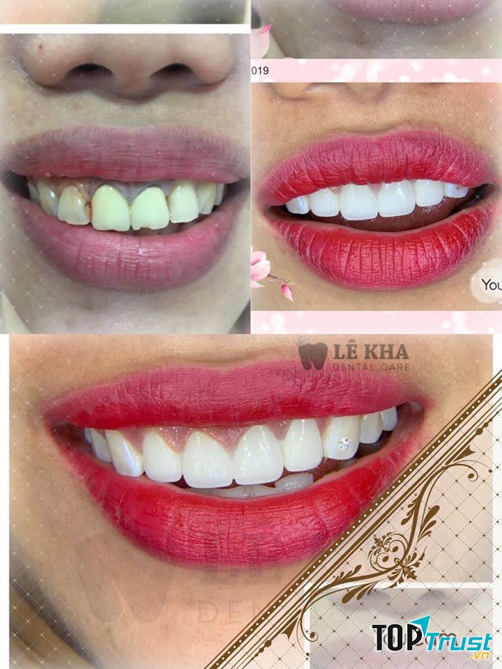 Địa chỉ tẩy trắng răng uy tín nhất TP. Thủ Dầu Một, Bình Dương