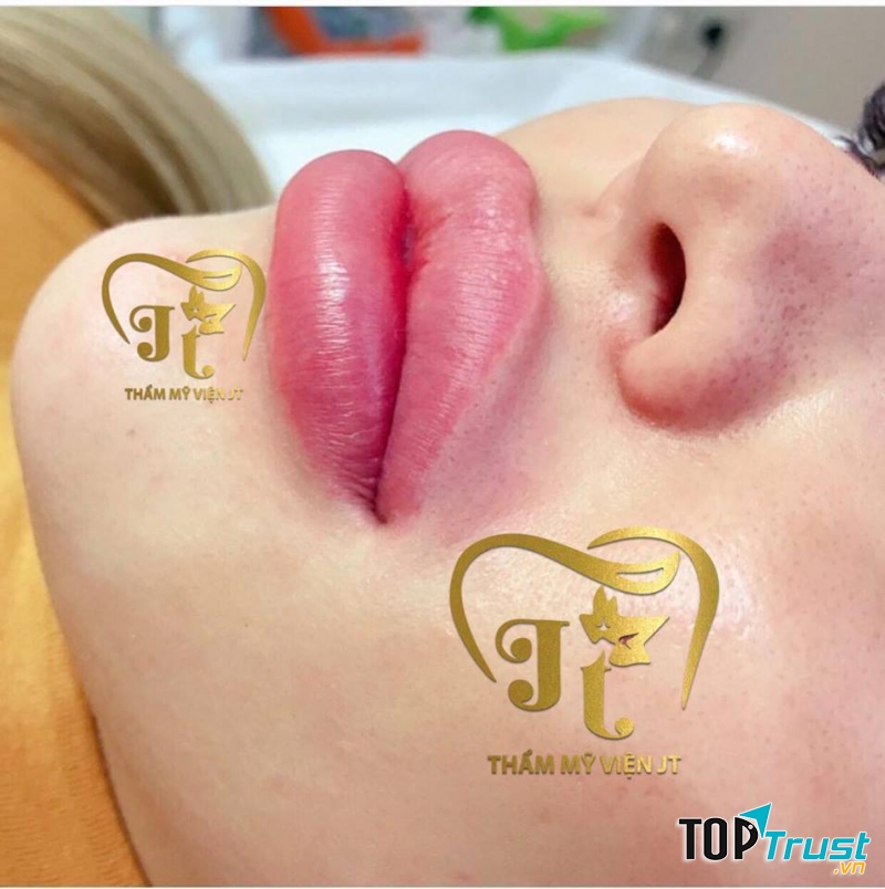 Địa chỉ tiêm filler - botox uy tín và chất lượng nhất Cần Thơ