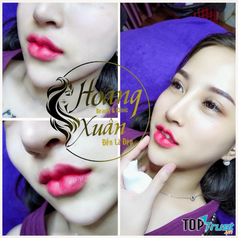 Địa chỉ tiêm filler - botox uy tín và chất lượng nhất Hải Phòng