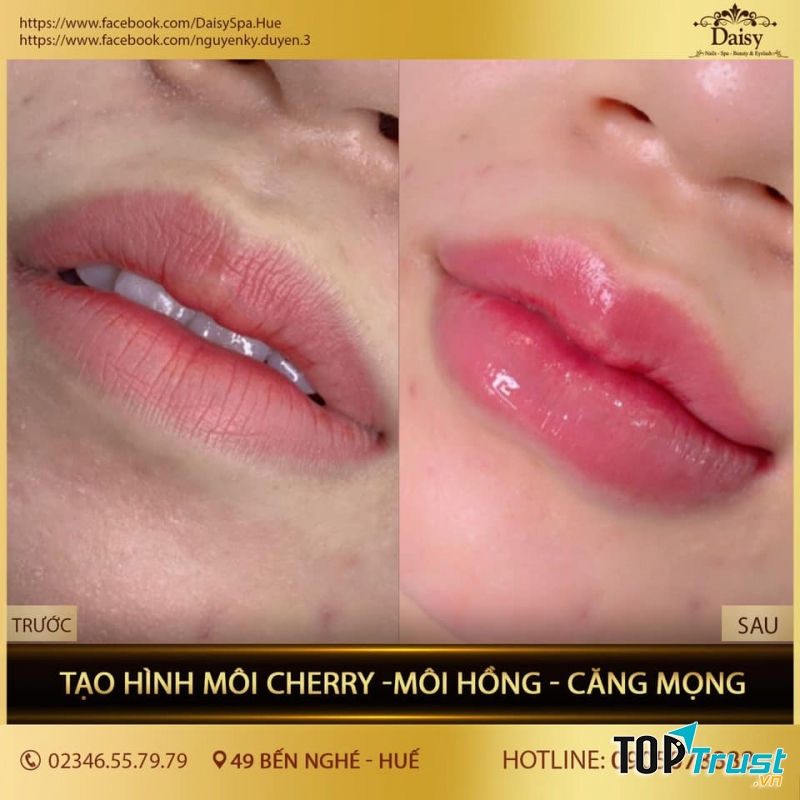 Địa chỉ tiêm filler - botox uy tín và chất lượng nhất Huế