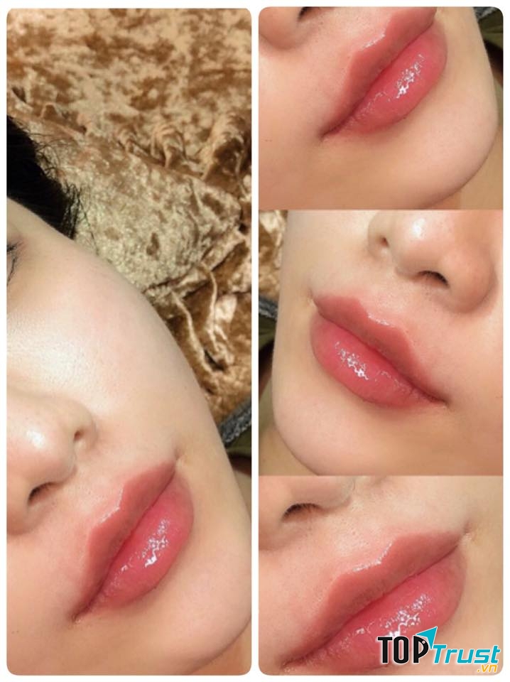 Địa chỉ tiêm filler - botox uy tín và chất lượng nhất Mỹ Tho, Tiền Giang