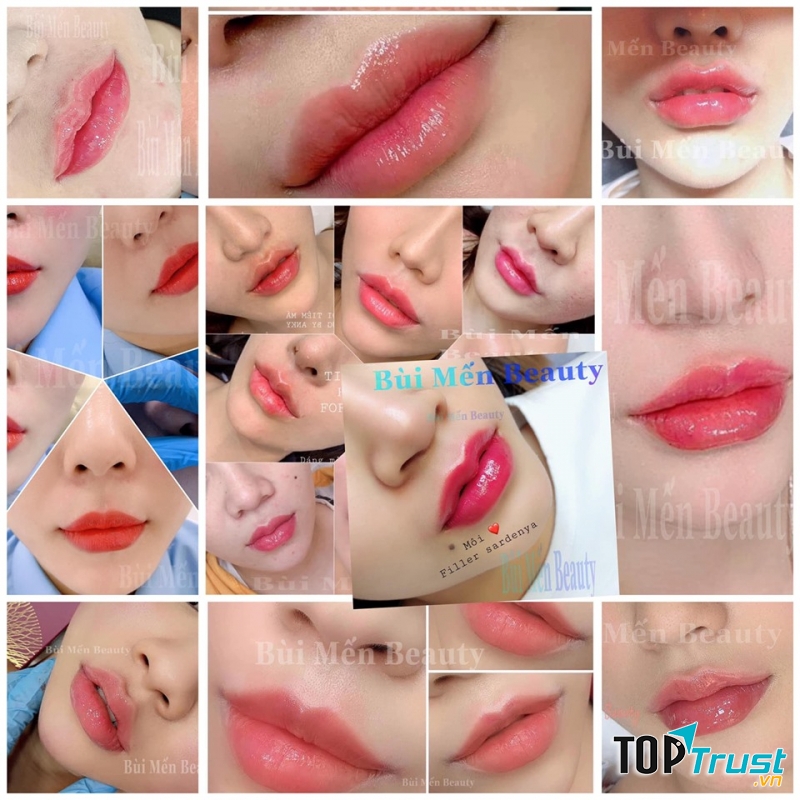 Địa chỉ tiêm filler - botox uy tín và chất lượng nhất Nha Trang