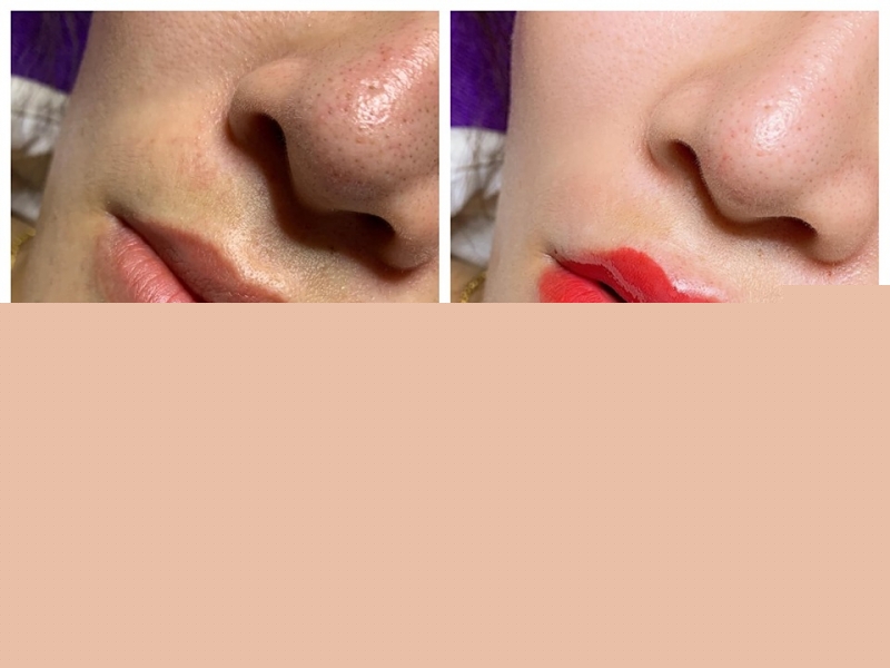 Địa chỉ tiêm filler - botox uy tín và chất lượng nhất Thanh Hóa