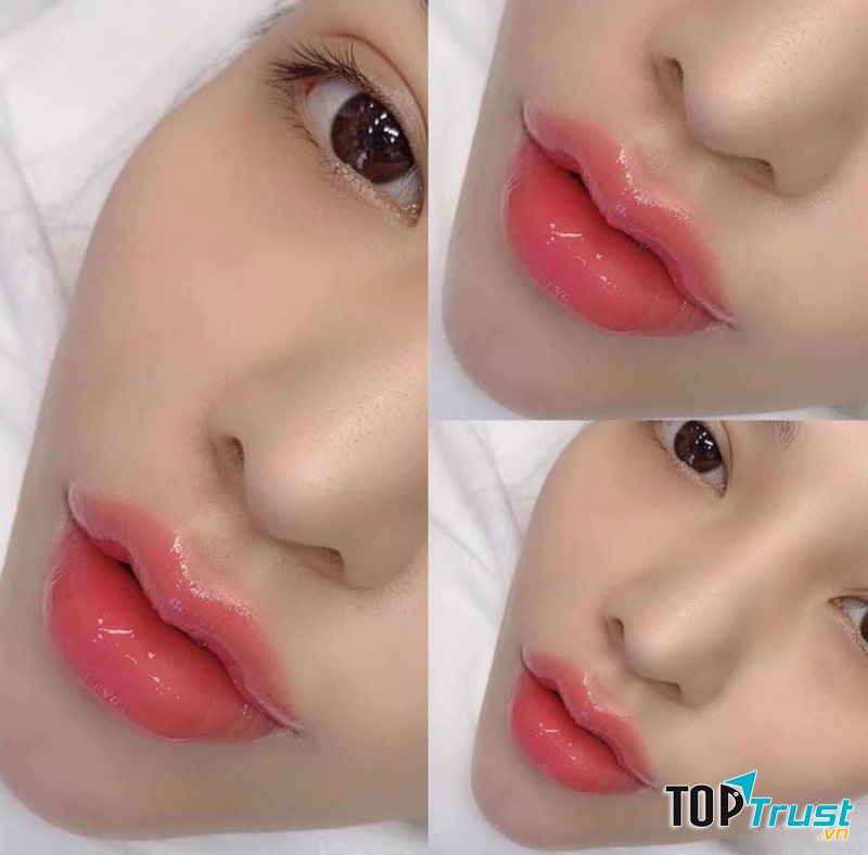 Địa chỉ tiêm filler - botox uy tín và chất lượng nhất TP. Vinh