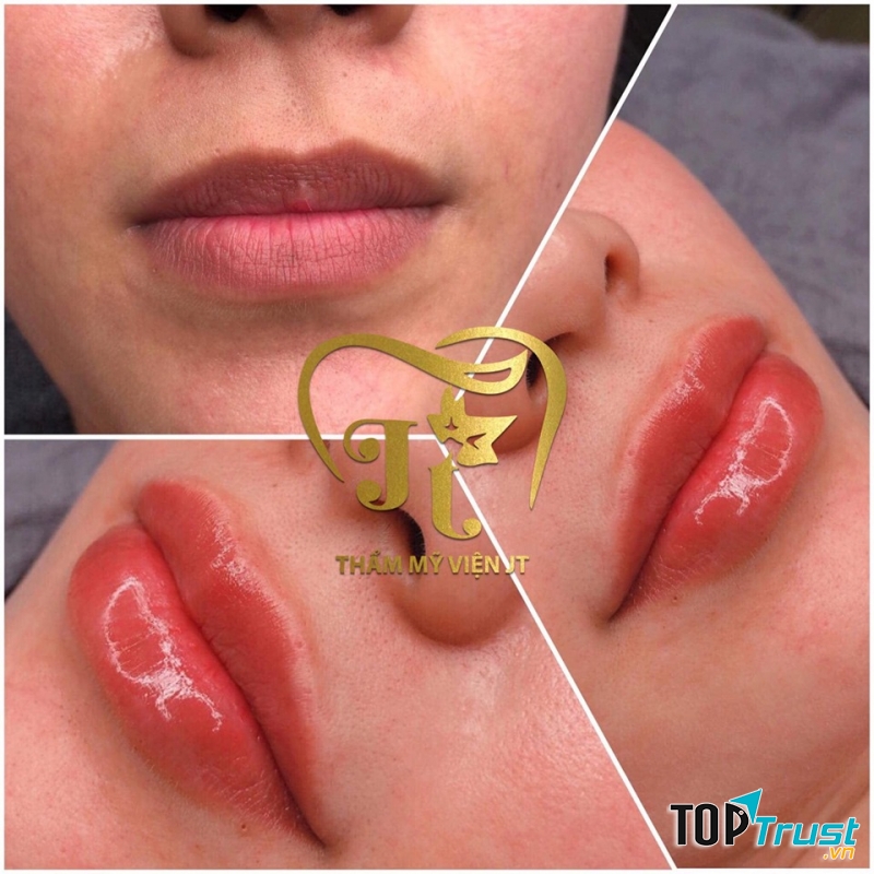 Địa chỉ tiêm môi đẹp và chất lượng nhất Cần Thơ