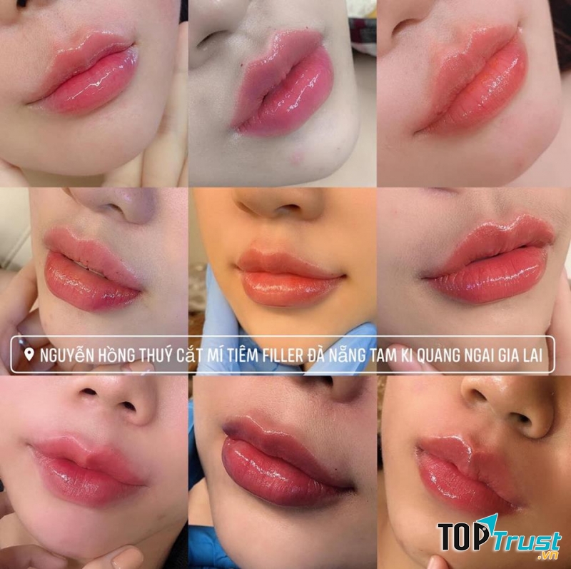 Địa chỉ tiêm môi đẹp và uy tín nhất Đà Nẵng