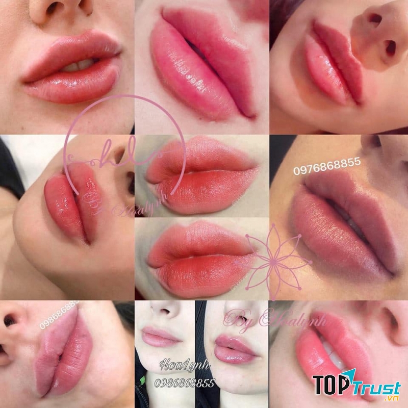 Địa chỉ tiêm môi đẹp và uy tín nhất tại Hà Nội