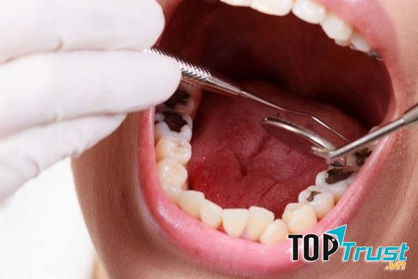 Địa chỉ trám răng uy tín nhất TP. Vinh, Nghệ An