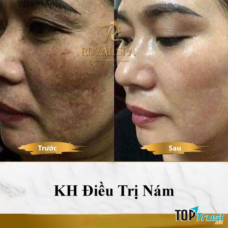 Địa chỉ trị nám hiệu quả nhất quận Đống Đa, Hà Nội